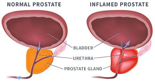 Prostatitis krónikus antibiotikumok kezelése