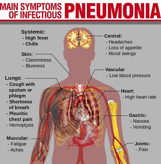 Pneumonia merupakan sebutan lain dari penyakit