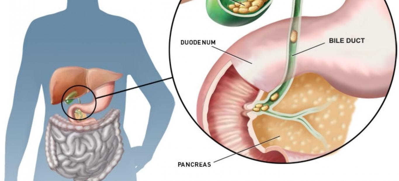 pdf-cholelithiasis-and-cholecystitis-front-view-of-the-gallbladder