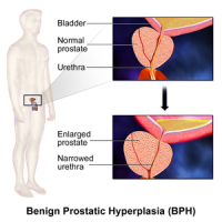 prostatic hyperplasia prostatita psihologica
