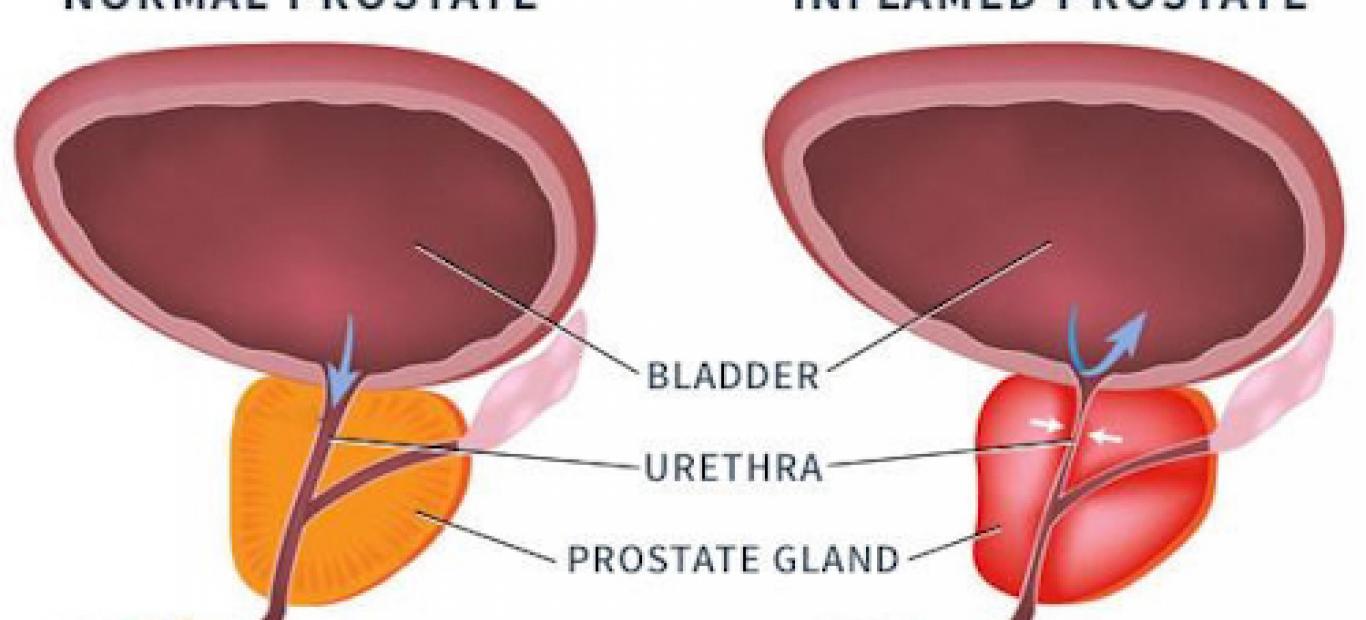 prostatita non bacteriana uretra si ureter